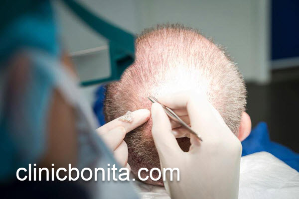 ماندگاری نتایج کاشت مو | کلینیک بنیتای اصفهان