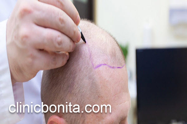 بررسی ماندگاری کاشت مو | کلینیک بنیتای اصفهان