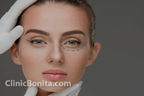 مراقبت های لازم بعد از بلفاروپلاستی