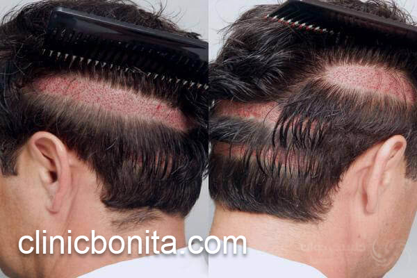 بررسی هزینه کاشت مو در اصفهان | کلینیک بنیتای اصفهان