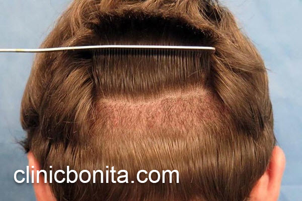 قیمت کاشت مو در اصفهان چقدر است؟ | کلینیک بنیتای اصفهان