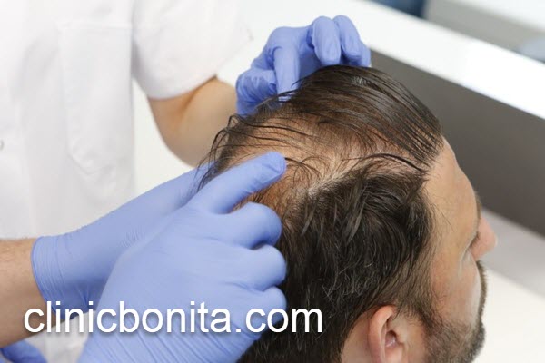 کاشت مو با بهترین تکنیک در اصفهان | کلینیک بنیتای اصفهان