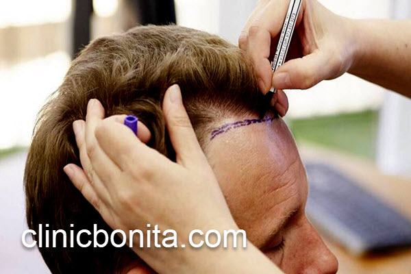 کاشت مو با بهترین تکنیک در اصفهان | کلینیک بنیتای اصفهان