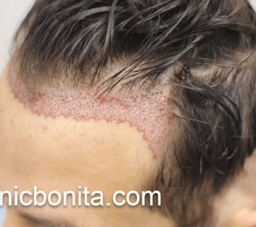 کاشت مو با بهترین قیمت در اصفهان | کلینیک بنیتای اصفهان