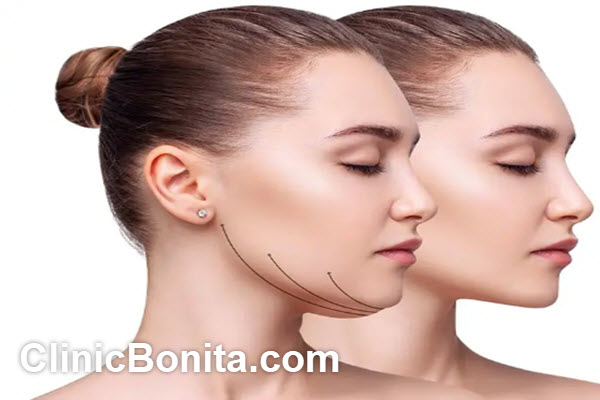 هزینه ساکشن غبغب در اصفهان | کلینیک بنیتا