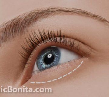 بهترین جراح پلک در اصفهان | کلینیک بنیتا