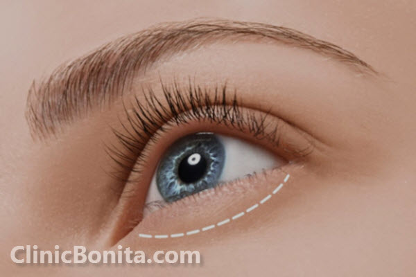 بهترین جراح پلک در اصفهان | کلینیک بنیتا