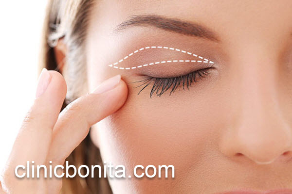 قیمت جراحی بلفاروپلاستی پلک بالا در 1403 | کلینیک بنیتای اصفهان