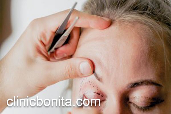 هزینه عمل بلفاروپلاستی پلک بالا در سال 1403 | کلینیک بنیتای اصفهان