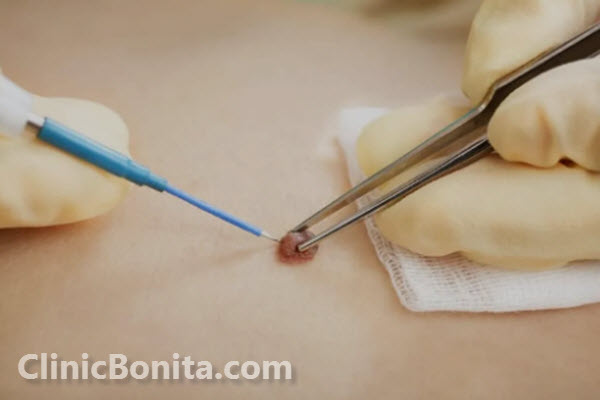 لیزر درمانی برای برداشتن زگیل و خال چیست؟