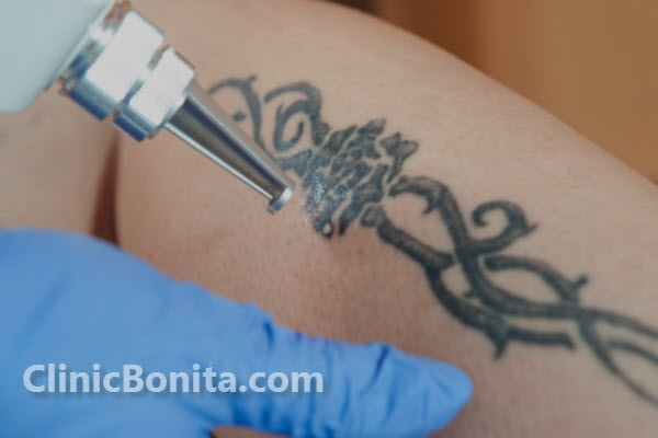 مراقبت های لازم برای قبل و بعد از پاک کردن تاتو با لیزر