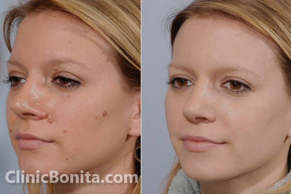 هزینه برداشتن خال و زگیل با لیزر چقدر است؟ | استان اصفهان