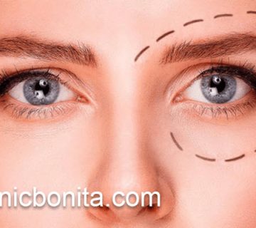 عمل بلفاروپلاستی پلک بالا در کلینیک تخصصی | کلینیک بنیتای اصفهان