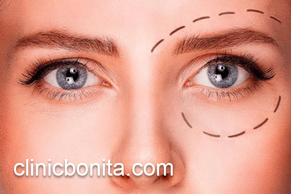 عمل بلفاروپلاستی پلک بالا در کلینیک تخصصی | کلینیک بنیتای اصفهان