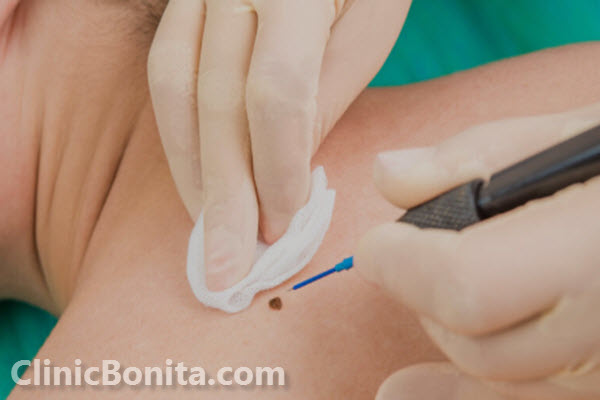 برداشتن خال و زگیل با لیزر به صورت حرفه ای