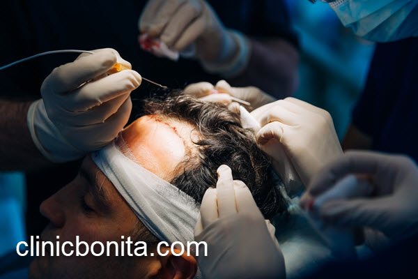 بهترین سن برای کاشت مو در آقایان | کلینیک بنیتای اصفهان