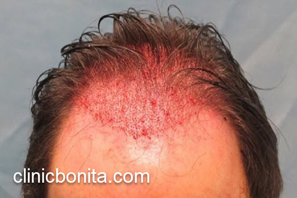 هزینه کاشت مو در اصفهان | کلینیک بنیتای اصفهان