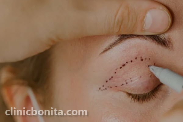 نحوه انجام جراح بلفاروپلاستی