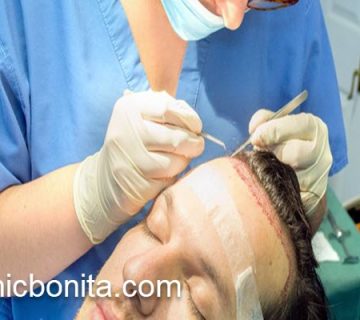 سن مناسب برای کاشت مو آقایان | کلینیک بنیتای اصفهان