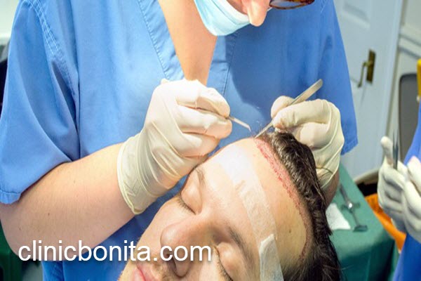 سن مناسب برای کاشت مو آقایان | کلینیک بنیتای اصفهان