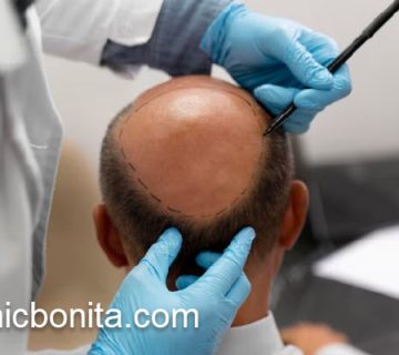 کاشت مو با بهترین قیمت در اصفهان | کلینیک بنیتای اصفهان