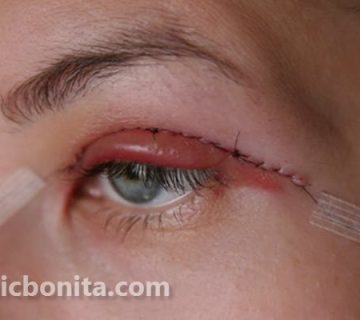 هزینه عمل افتادگی پلک در سال 1403