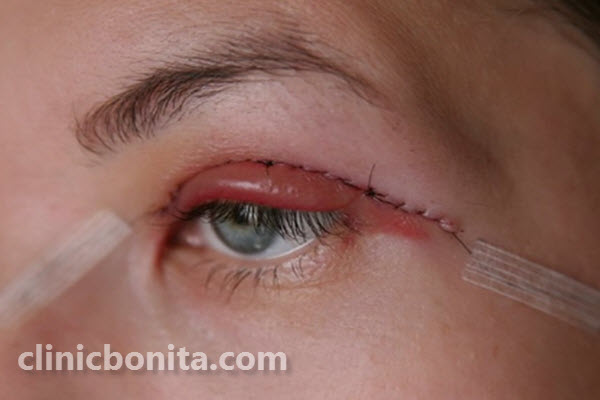 هزینه عمل افتادگی پلک در سال 1403