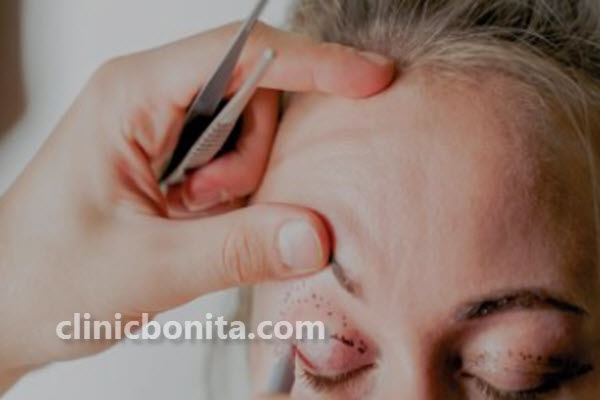 انواع بلفاروپلاستی | کلینیک بنیتا اصفهان