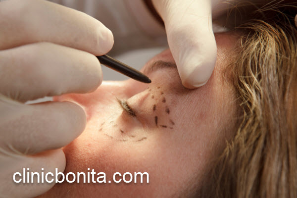 درمان افتادگی پلک با بلفاروپلاستی لیزر یا جراحی | کلینیک بنیتای اصفهان