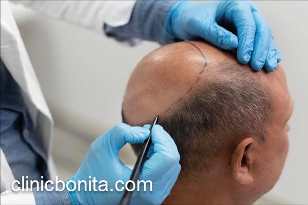 بهترین تکنیک کاشت مو با تراکم بالا | کلینیک بنیتای اصفهان