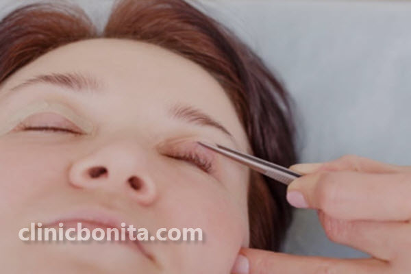 مراقبت از بلفاروپلاستی چگونه صورت می پذیرد؟