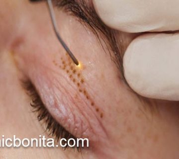 عمل بلفاروپلاستی با لیزر و جراحی | کلینیک بنیتای اصفهان