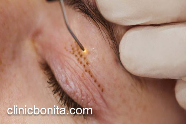 عمل بلفاروپلاستی با لیزر و جراحی | کلینیک بنیتای اصفهان