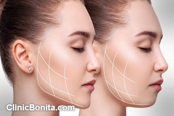 هزینه عمل بوکال فت صورت چقدر است؟ | کلینیک بنیتای اصفهان