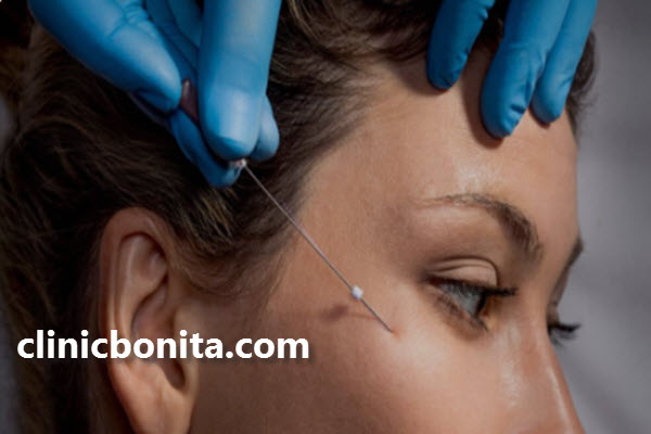 لیفت صورت با نخ چیست؟