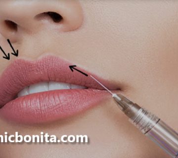 تزریق ژل لب مدل روسی در اصفهان