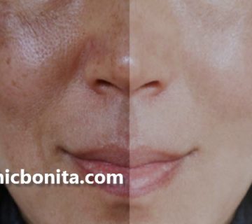 چند جلسه مزوتراپی برای لک صورت لازم است؟