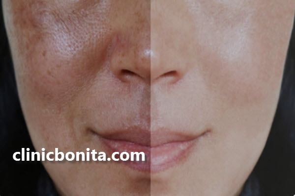 چند جلسه مزوتراپی برای لک صورت لازم است؟