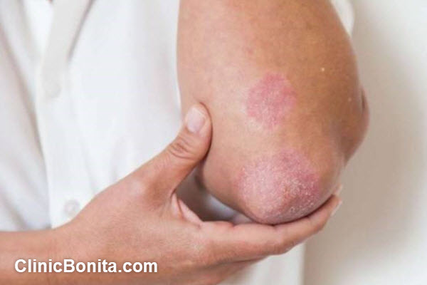 ویژگی های بهترین دکتر بیماری قارچ پوستی در اصفهان | کلینیک بنیتا