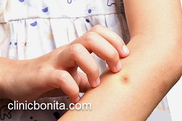 آشنایی با بهترین دکتر برای درمان سالک | کلینیک بنیتای اصفهان