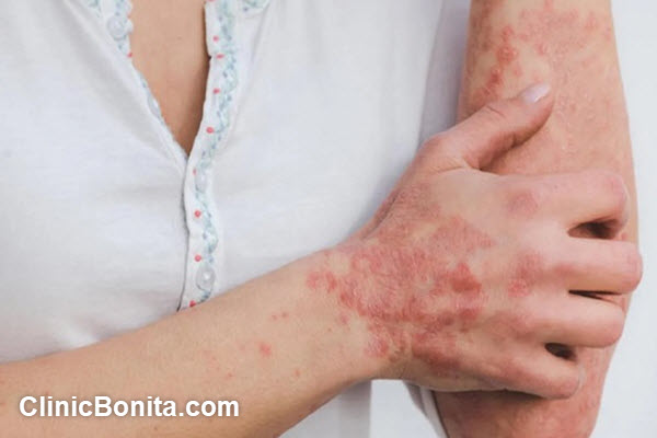 هزینه درمان قارچ پوستی در اصفهان چقدر است؟ | کلینیک بنیتا