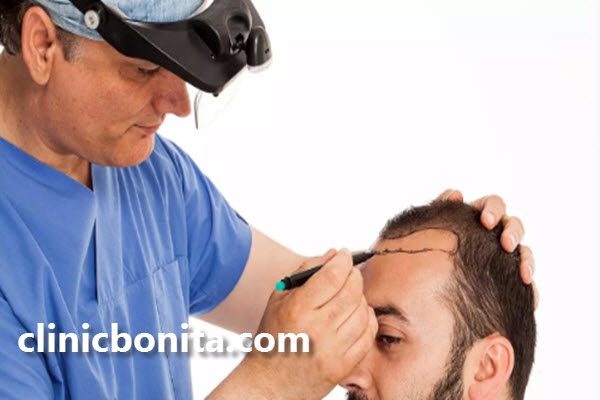 بهترین روش کاشت مو چیست؟