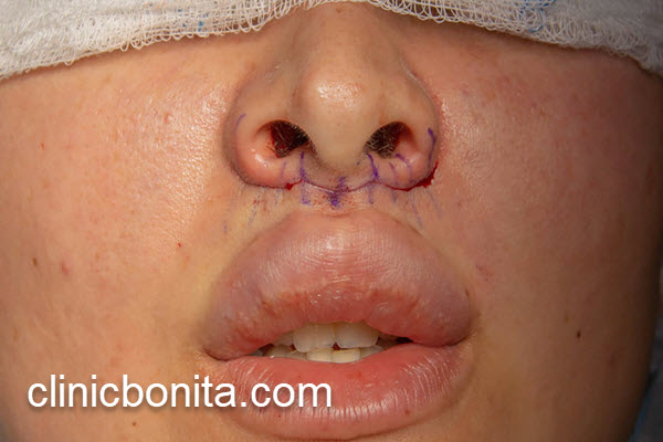 هزینه سانترال لب در اصفهان | کلینیک بنیتای اصفهان