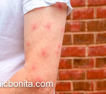 درمان سالک توسط بهترین پزشک | کلینیک بنیتای اصفهان