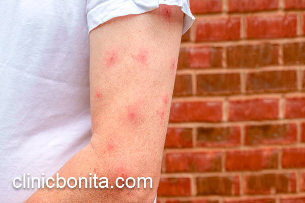 درمان سالک توسط بهترین پزشک | کلینیک بنیتای اصفهان