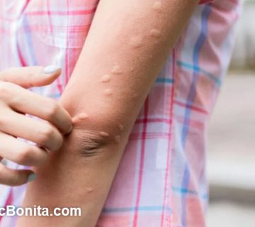 بهترین دکتر بیماری قارچ پوستی در اصفهان | کلینیک بنیتا