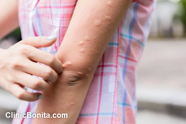 بهترین دکتر بیماری قارچ پوستی در اصفهان | کلینیک بنیتا