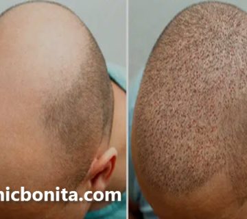 جدیدترین روش کاشت مو در اصفهان