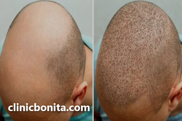 جدیدترین روش کاشت مو در اصفهان