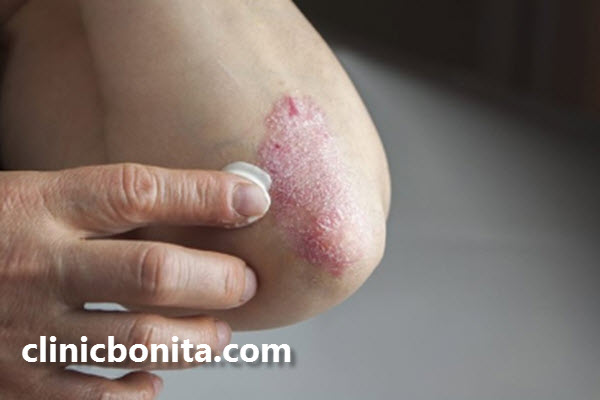 انواع بیماری پسوریازیس کدام است؟